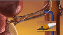 RDN Procedure 2 - Catheter-based Energy Delivery